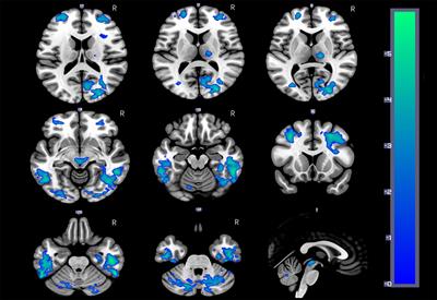 Decreased Relative Cerebral Blood Flow in Unmedicated Heroin-Dependent Individuals